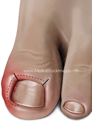Ingrowing Toenail Treated with Surgical Intervention called Zadek’s Procedure (Adult)