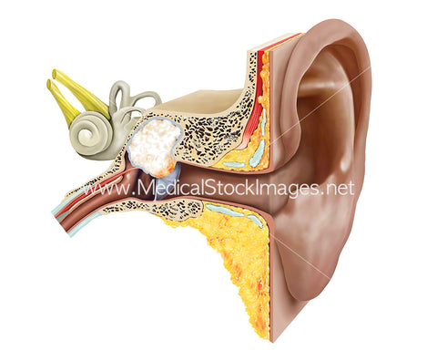 Middle Ear Cholesteatoma