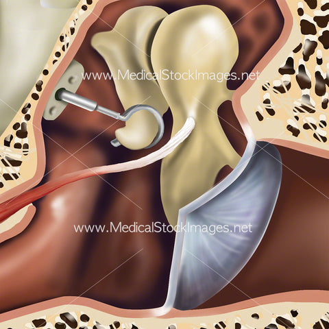 Middle Ear Implant