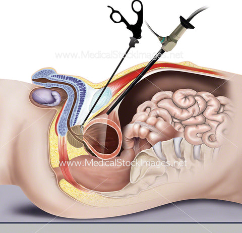 Laparoscopic Surgery for Prostate