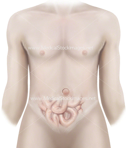 Umbilical Hernia on an Adult