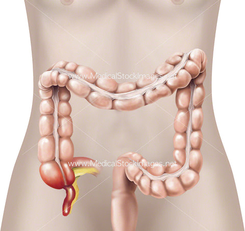Inflamed Appendix and Large Bowel