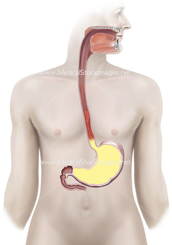Gastroesophageal Reflux Disease Showing an Inflamed Oesophagus