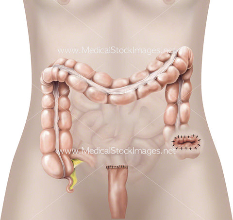 Hartmanns Procedure with a Stoma