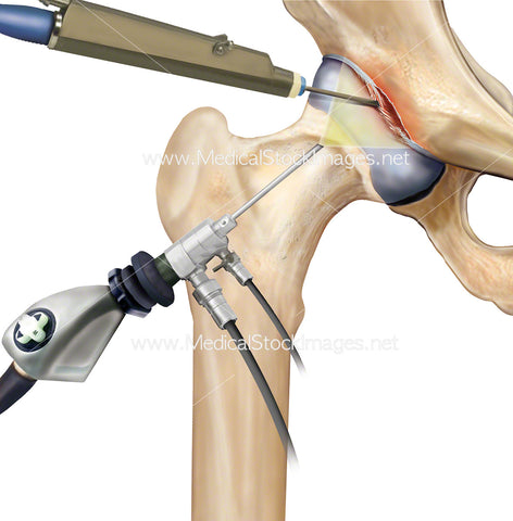 Arthroscopy of the Hip Joint