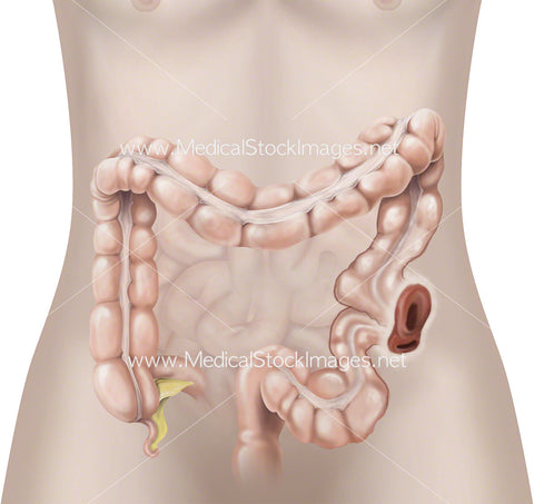 Bowel Surgery Creating a Stoma