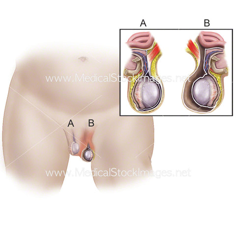 Hydrocele Testicle in an Infant