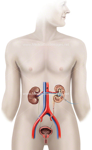 Kidney Nephrostomy Catheter