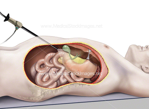 Laparoscopic Surgery Gallbladder