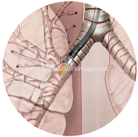 Endobronchial Ultrasound Procedure