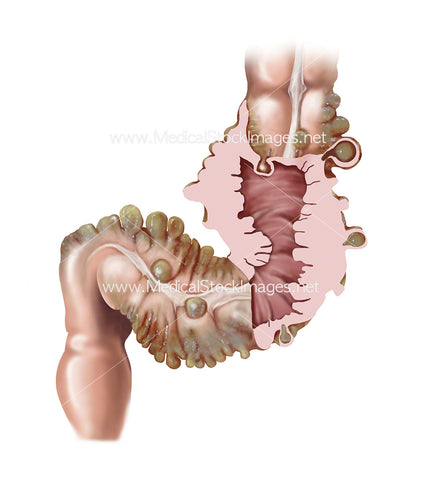 Close up of Diverticulitis in the Large Bowel