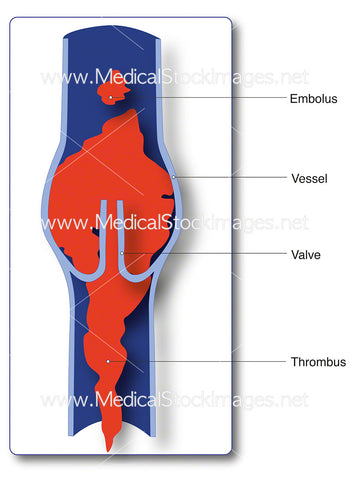 Thrombus in Vessel