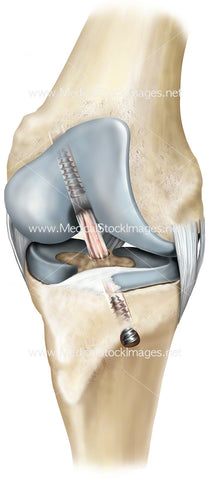 Surgical Repair of Cruciate Ligament