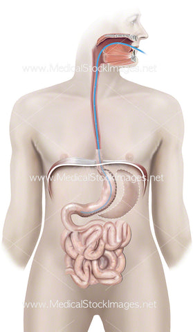 Sleeve Gastrectomy Showing Stomach Removal