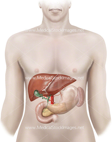 Distal Pancreatectomy Procedure