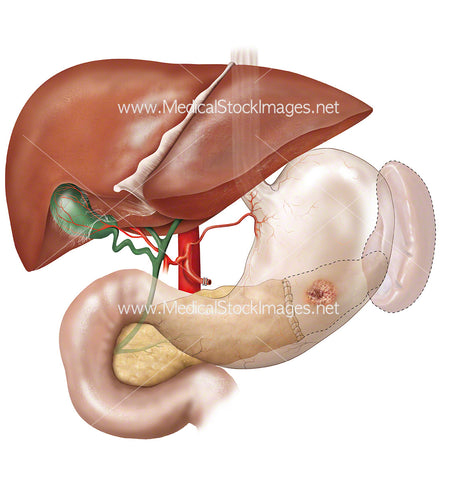 Tumour with Pancreas Removed