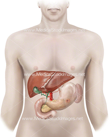Person Showing Pancreas Tumour Removed