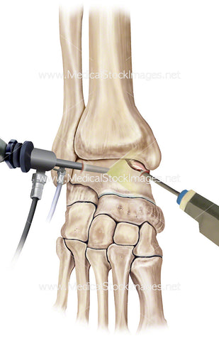 Ankle Arthroscopy