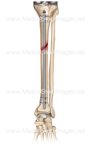 Tibia Fracture Repair