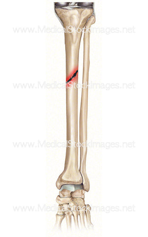 Tibia Fracture