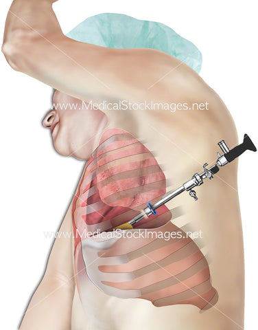 Thoracoscopy Telescope in Pleural Space Lung