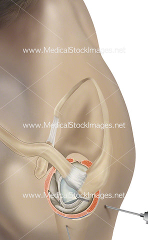 Frozen Shoulder Repair Surgery