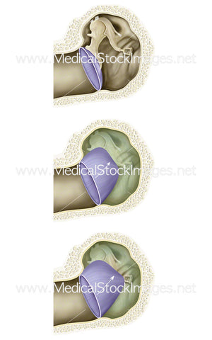 Tympanic Membrane Retraction (Middle Ear Atelectasis)