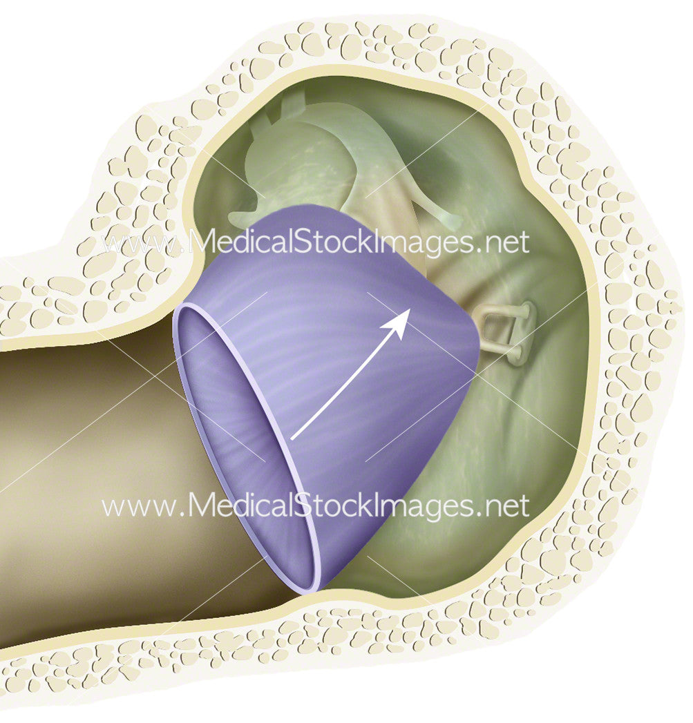Timpanic Mem Retraction Tympanic Retraction (Middle Ear Atelectasis) – Medical Stock Images Company