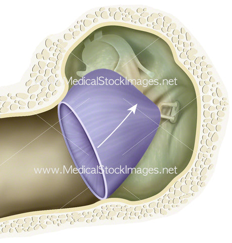 Tympanic Retraction (Middle Ear Atelectasis)