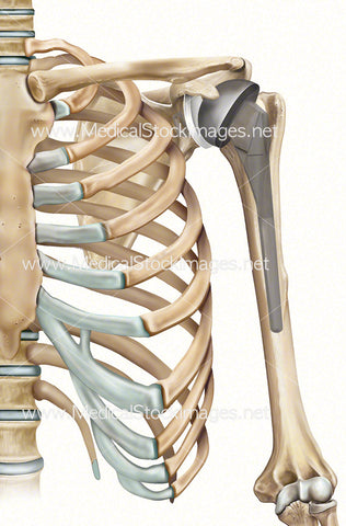 Shoulder Joint Replacement using Prosthesis