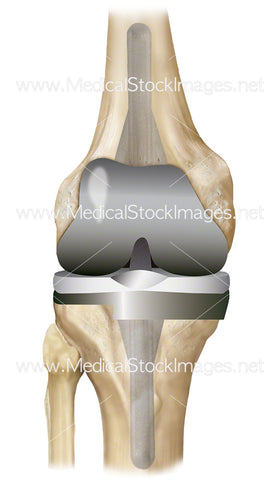 Knee Replacement with Prosthesis