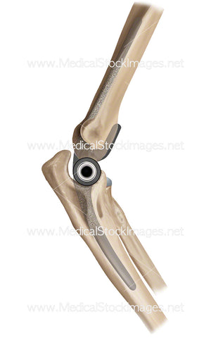 Elbow Joint Replacement