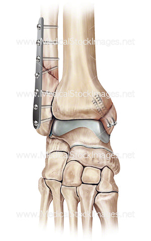 Plate and Screw Fixation Ankle