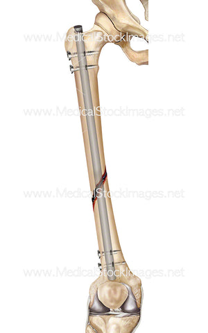 Femur Surgical Repair