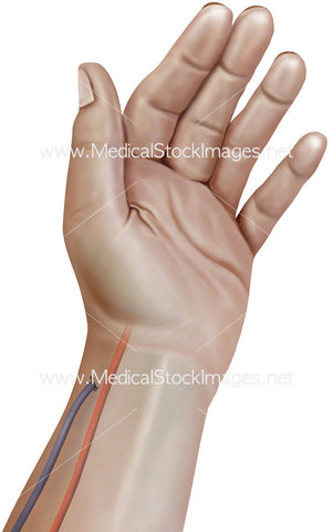 Fistula Ligated Wrist Cephalic Vein