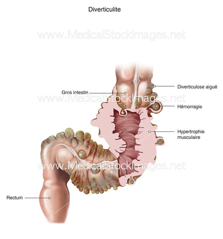 Diverticulite