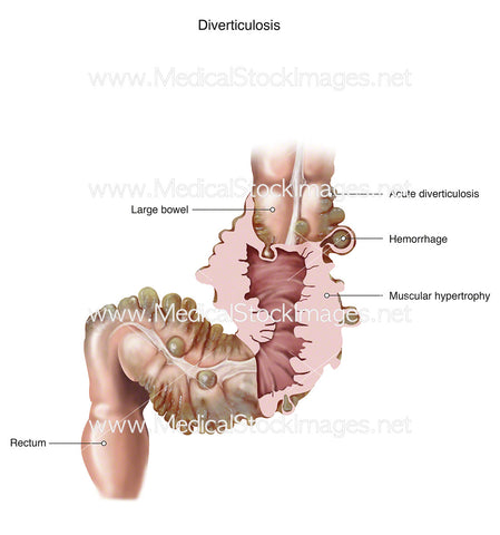 Diverticulosis