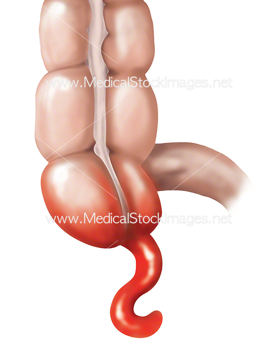 Retroverted Appendix Inflamed Appendix Ultrasound: A Safer Way To Diagnose Appendicitis In
