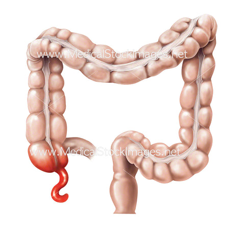 Bowel with Inflamed Appendix