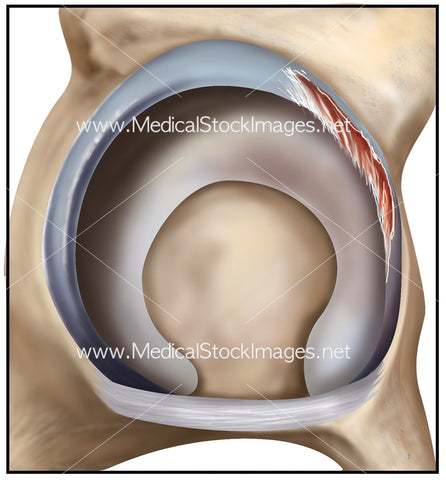 Acetabulum Tears