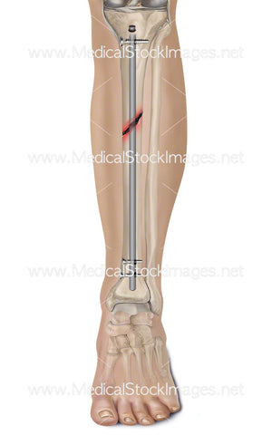 Tibia Fracture and Repair
