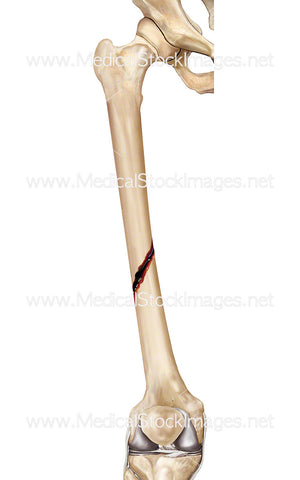 Femur Fracture