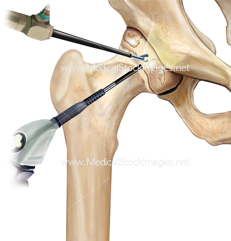 Hip Arthroscopy and Arthritis