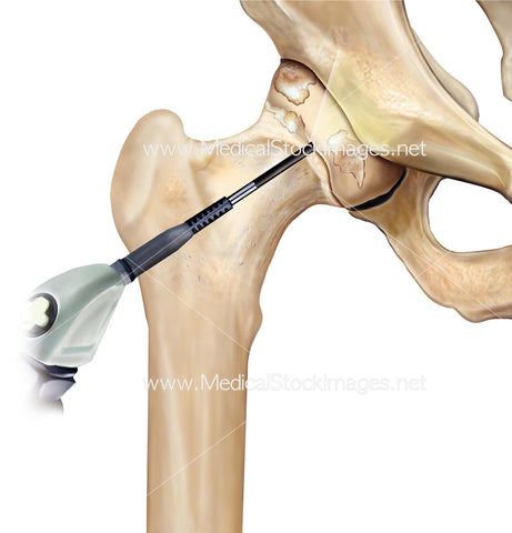 Hip Arthroscopy Camera and Arthritis