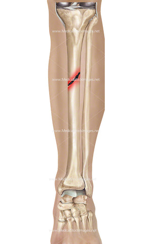 Tibia Fracture with Leg