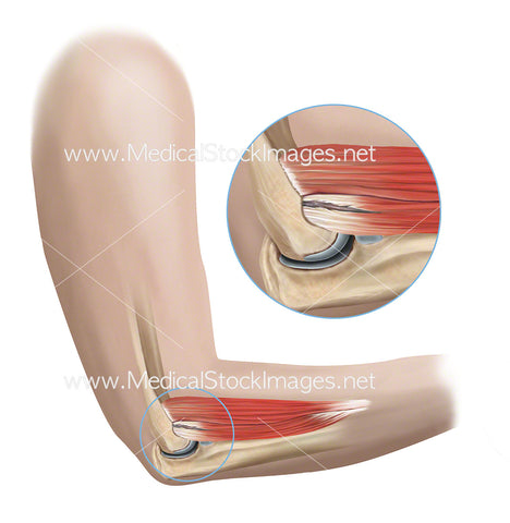Tennis Elbow with Muscle Tears