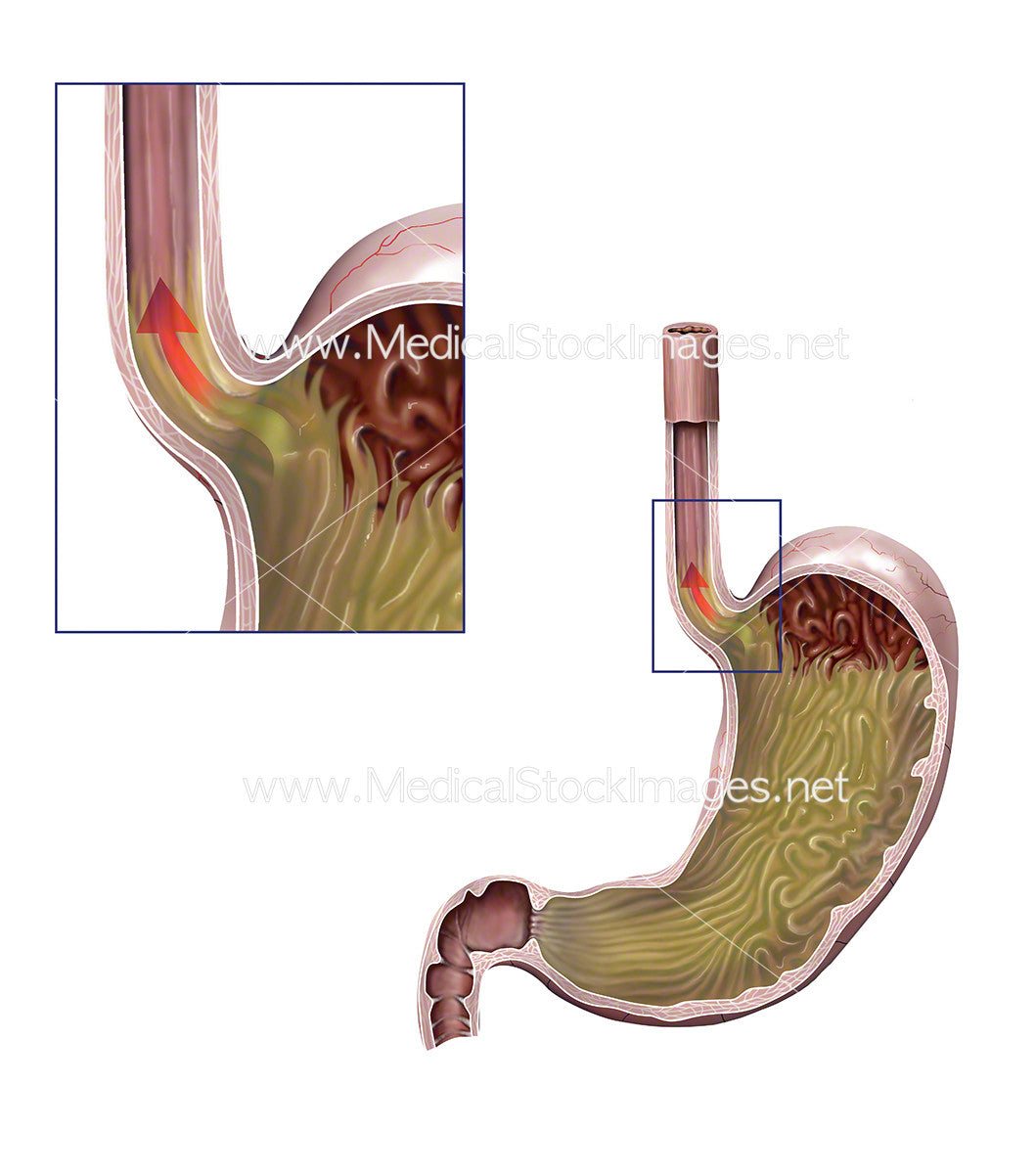 Lower Esophageal Ring - Gastrointestinal Disorders - Merck Manuals  Professional Edition