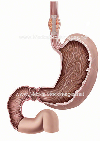 Stent with Tumour in Oesophagus