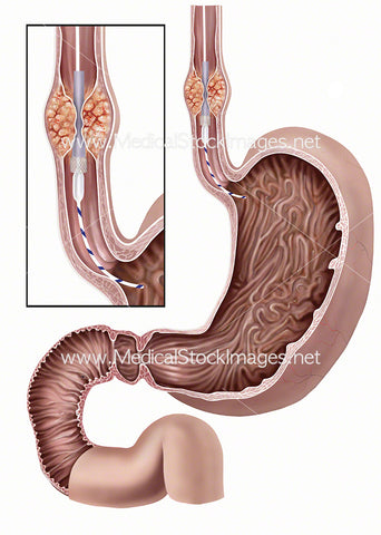 Stent call out Implantation with Tumour in Oesophagus