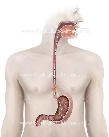 Stent Oesophagus Implantation with Figure Background